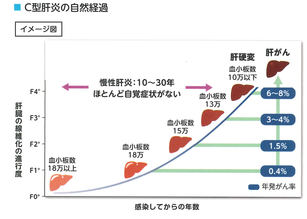 C型肝炎の自然経過